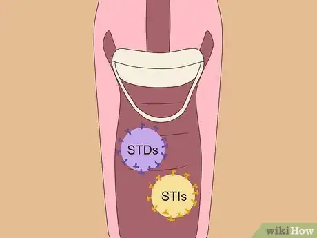 Image titled Use the Birth Control Sponge Step 17