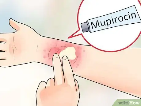 Image titled Get Rid of Eczema and Staph Step 2