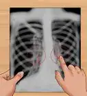 Read a Chest X Ray