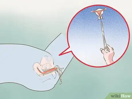 Image titled Get an IUD Taken Out Step 6