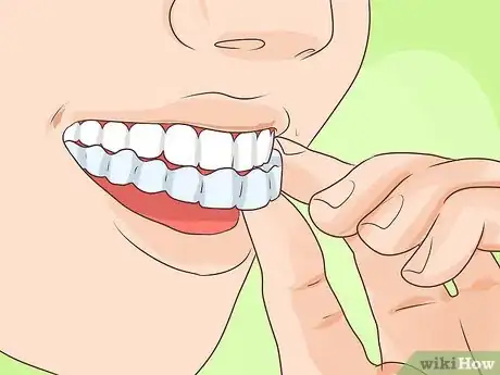 Image titled Put on a Retainer Step 8