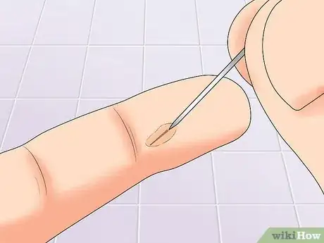 Image titled Remove Splinters in Children Step 12