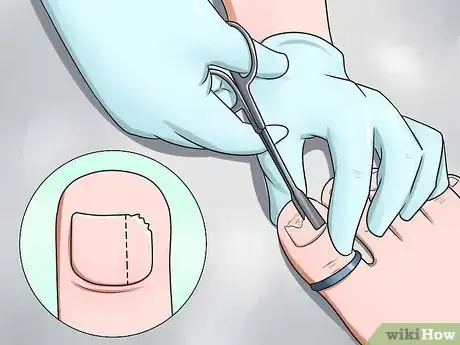 Image titled Prevent Nail Fungus Step 12