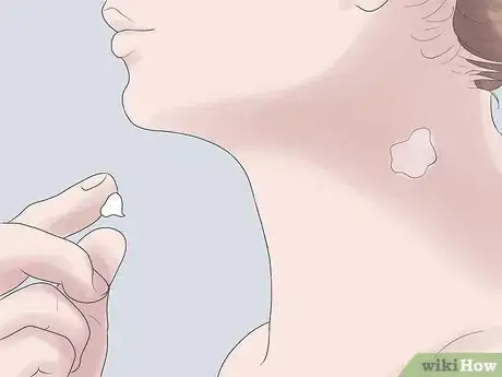 Image titled Get Rid of a Hickey Fast Step 5