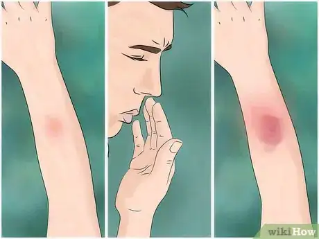 Image titled Identify and Treat Recluse (Fiddleback) Spider Bites Step 2