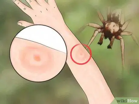 Image titled Identify a Spider Bite Step 2