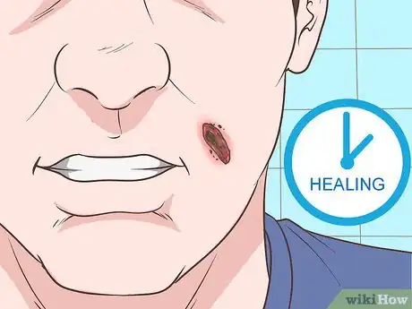 Image titled Heal Scabs on Your Face Step 6