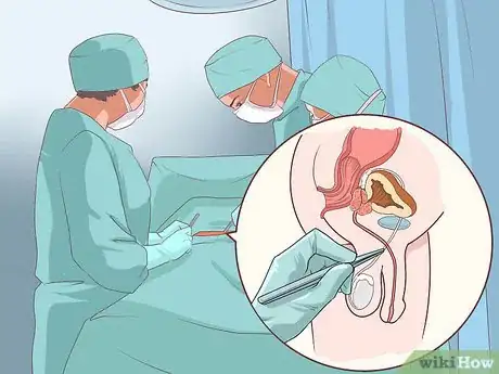 Image titled Treat Testicular Cancer Step 1