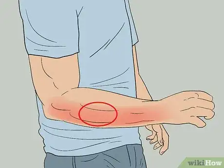 Image titled Cure Forearm Pain Step 5