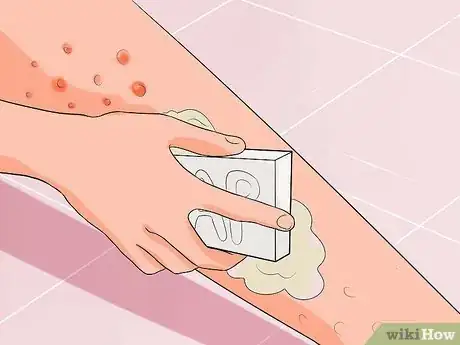 Image titled Get Rid of a Rash from Nair Step 9