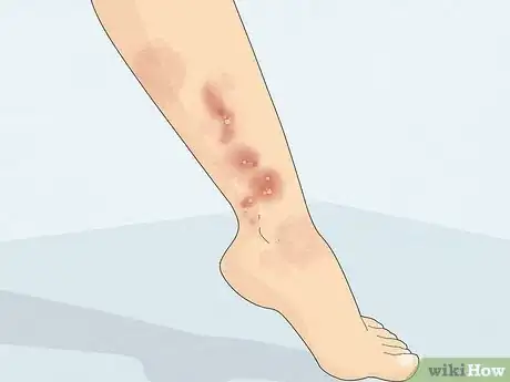 Imagen titulada Dry Up Poison Ivy Rash Step 12