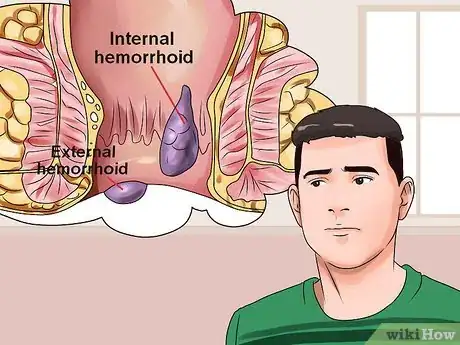 Imagen titulada Stop Hemorrhoid Pain Step 1