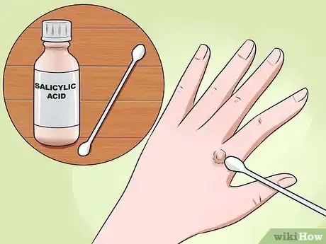 Imagen titulada Get Rid of Warts on Hands Step 2