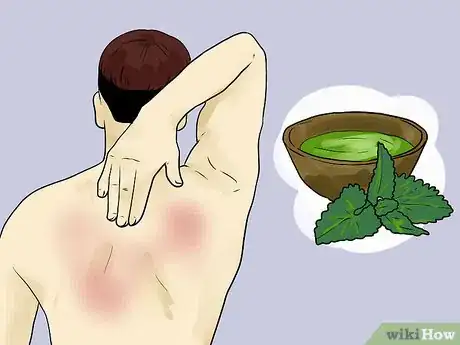 Imagen titulada Prevent Skin Peeling After Sunburn Step 10