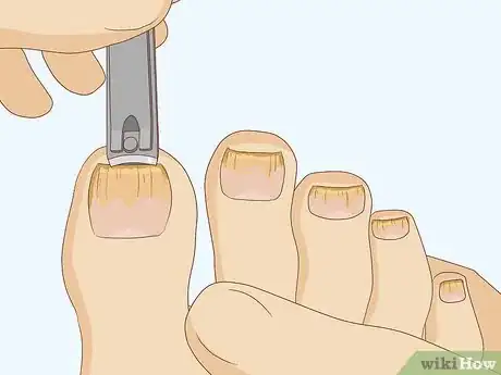 Imagen titulada Cure Toenail Fungus with Vinegar Step 1