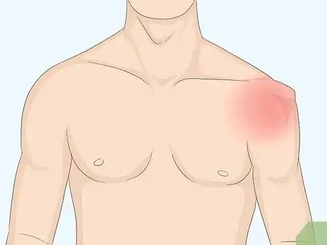 Imagen titulada Fix a Dislocated Shoulder Step 1