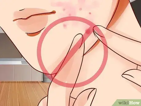 Imagen titulada Get Rid of a Hard Pimple Step 19