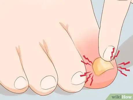 Imagen titulada Treat a Swollen Toe Step 2