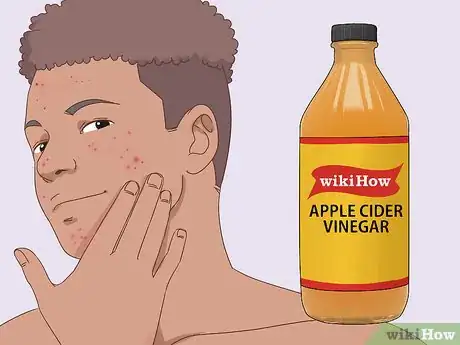 Imagen titulada Get Rid of Acne Fast Step 8