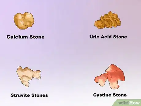 Imagen titulada Dissolve Kidney Stones Step 3