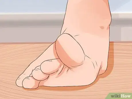 Imagen titulada Relieve Bunions Step 9