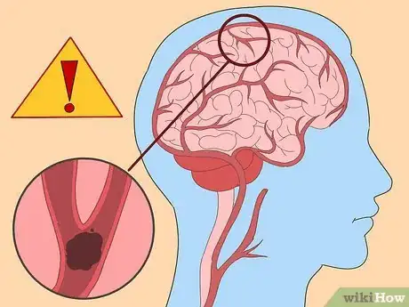 Imagen titulada Dissolve Blood Clots Step 4