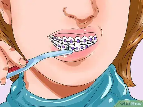 Imagen titulada Clean Teeth With Braces Step 4