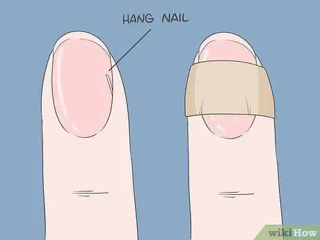 Imagen titulada Heal Hangnails Fast Step 1