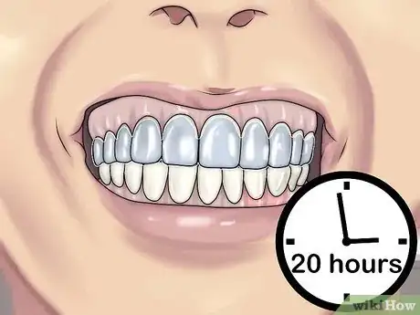 Imagen titulada Get Straight Teeth Without Braces with Invisalign Step 8