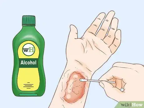 Imagen titulada Get Rid of Poison Ivy Rashes Step 5