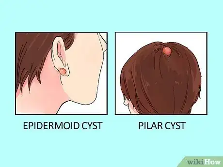 Imagen titulada Treat a Cyst Step 1