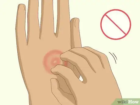 Imagen titulada Get Rid of Ringworm Naturally Step 10