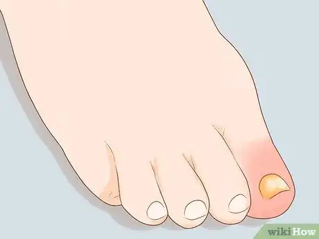 Imagen titulada Treat a Swollen Toe Step 1