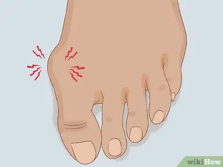 Imagen titulada Treat a Swollen Toe Step 3