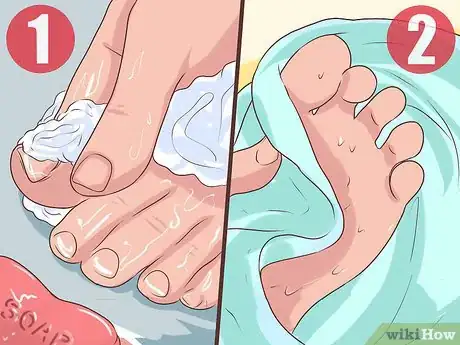 Imagen titulada Treat a Torn Toenail Step 3