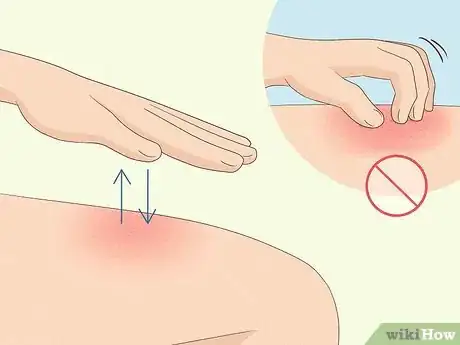 Imagen titulada Get Rid of Itchy Skin with Home Remedies Step 10