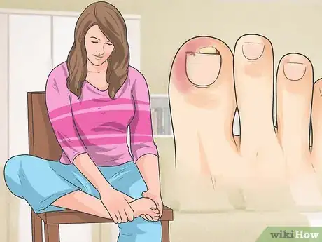 Imagen titulada Tell if You Have an Ingrown Toenail Step 2