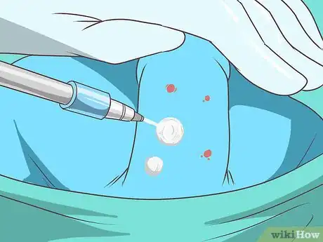 Imagen titulada Get Rid of Genital Warts Step 10