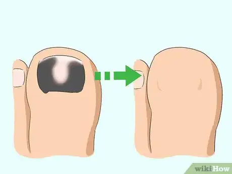 Imagen titulada Treat a Black Toenail Step 16