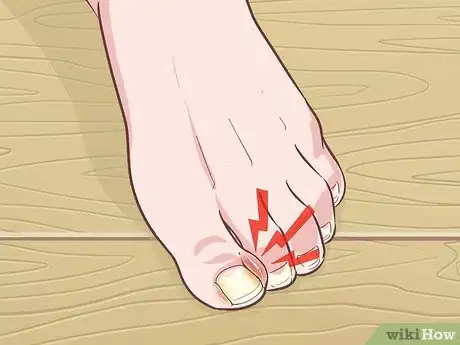 Imagen titulada Cut an Ingrown Toenail Step 9