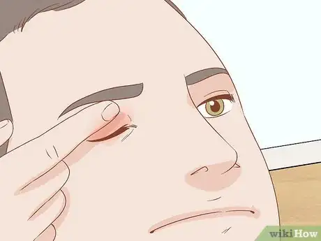 Imagen titulada Heal a Swollen Eyelid Step 10