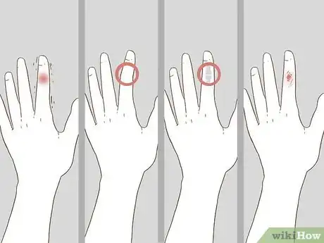 Imagen titulada Determine if a Finger Is Broken Step 13