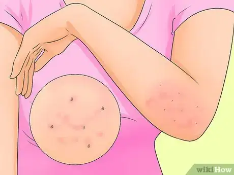 Imagen titulada Cure Scabies Step 1