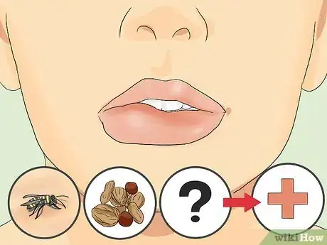 Imagen titulada Heal a Swollen Lip Step 1