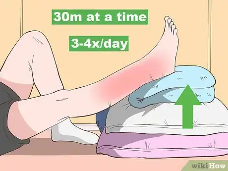 Imagen titulada Reduce Leg Swelling Step 1