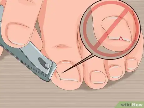 Imagen titulada Remove Infection from an Ingrown Toenail Step 8