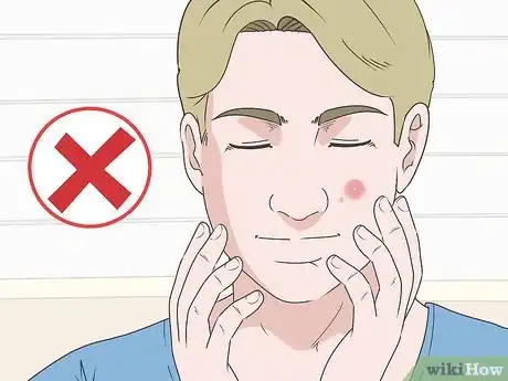 Imagen titulada Get Rid of a Blind Pimple Step 19