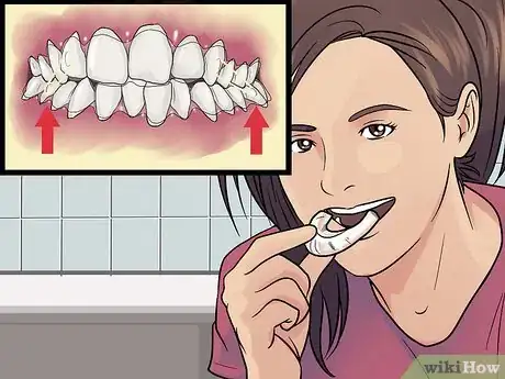 Imagen titulada Get Straight Teeth Without Braces with Invisalign Step 9