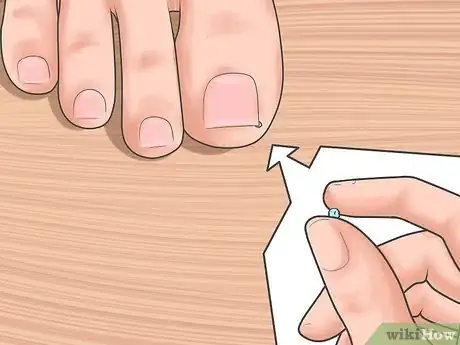 Imagen titulada Tell if You Have an Ingrown Toenail Step 7