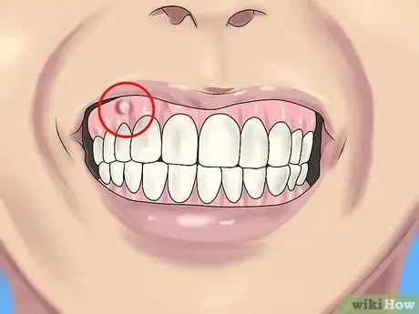 Imagen titulada Reduce Jaw Pain Step 5